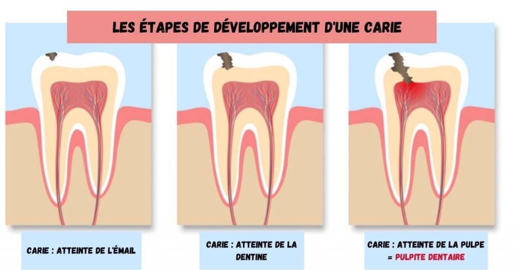 Schéma en trois étape du développement d'une carie. Ateinte de l'émail, de la dentine et puis de la pulpe. 