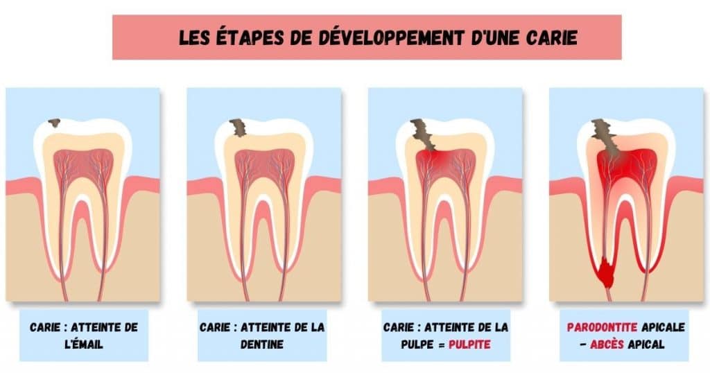 Les 4 étapes de développement d'une carie : émail, dentine, pulpe (pulpite) et parodontite.