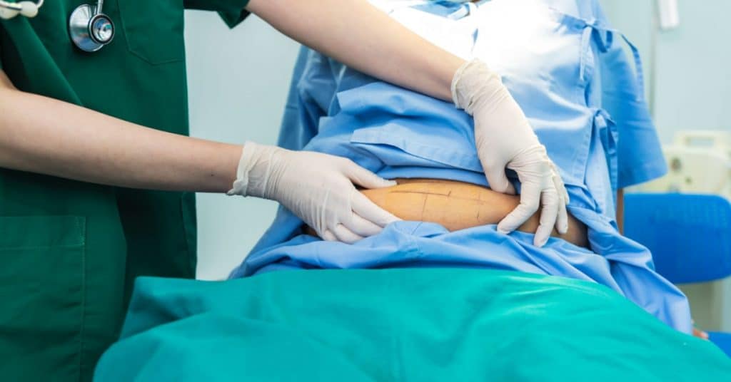 Opération liposuccion. Femme couchée sur une table pour une opération de liposuccion