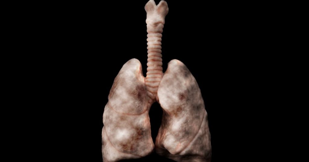 maladie pulmonaire à cause d'exposition à l'amiante
