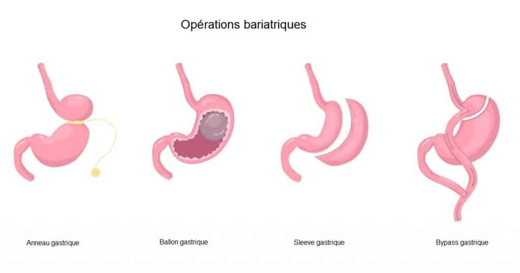 Les différents types de chirurgies bariatriques 