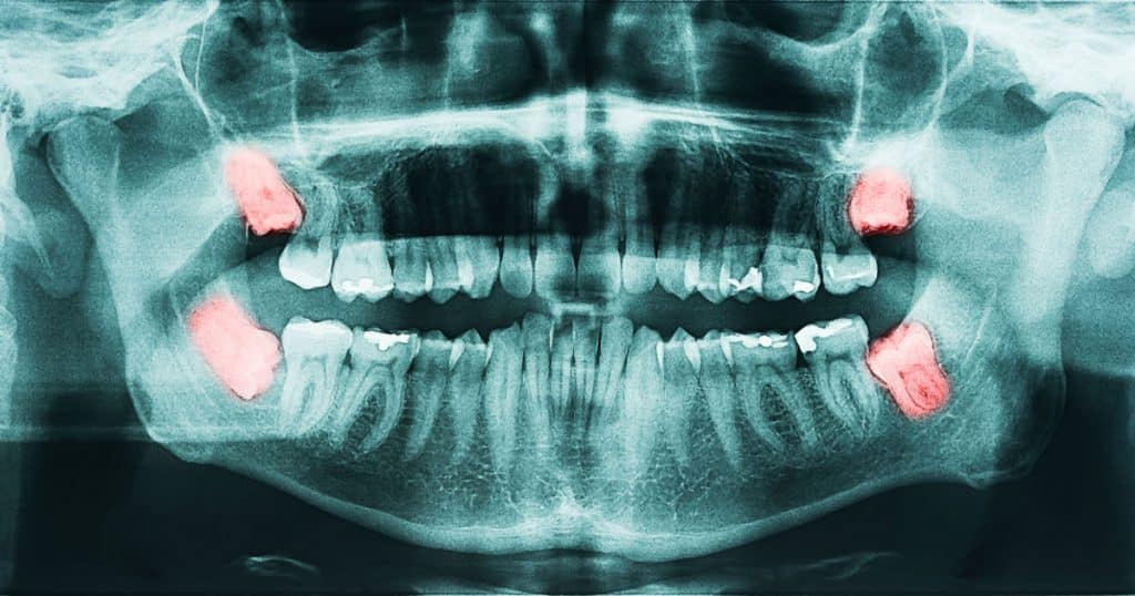 Une radiographie dentaire met en évidence en rouge les dents de sagesse d'un patient. 