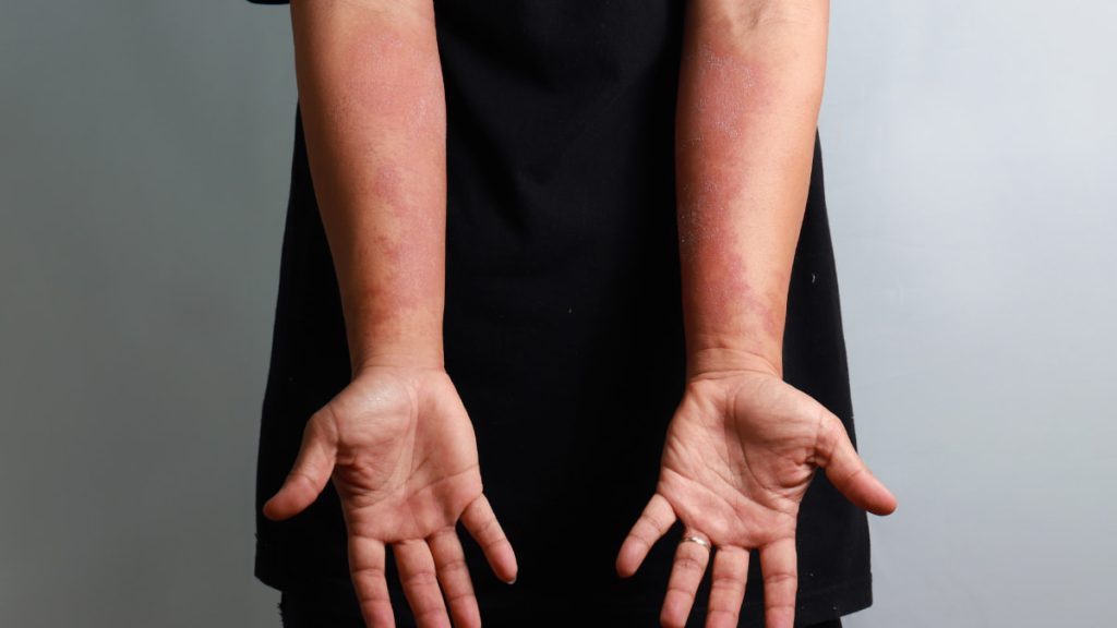 eczéma sur les avants bras 
