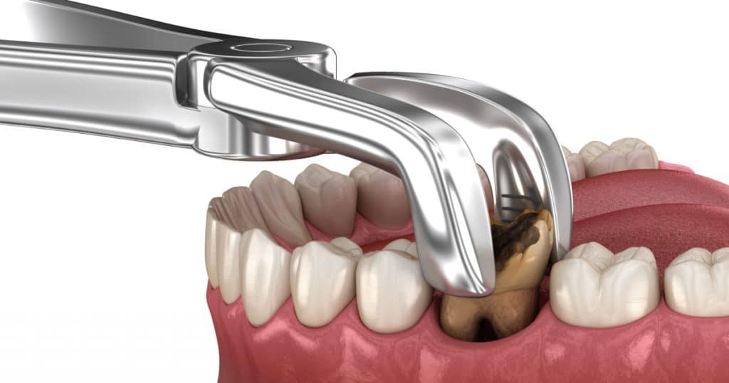 Extraction d'une dent brunâtre. 