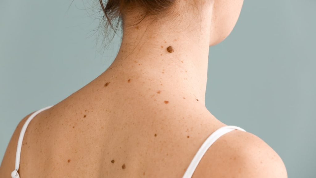 grains de beauté sur le dos d'une femme 
