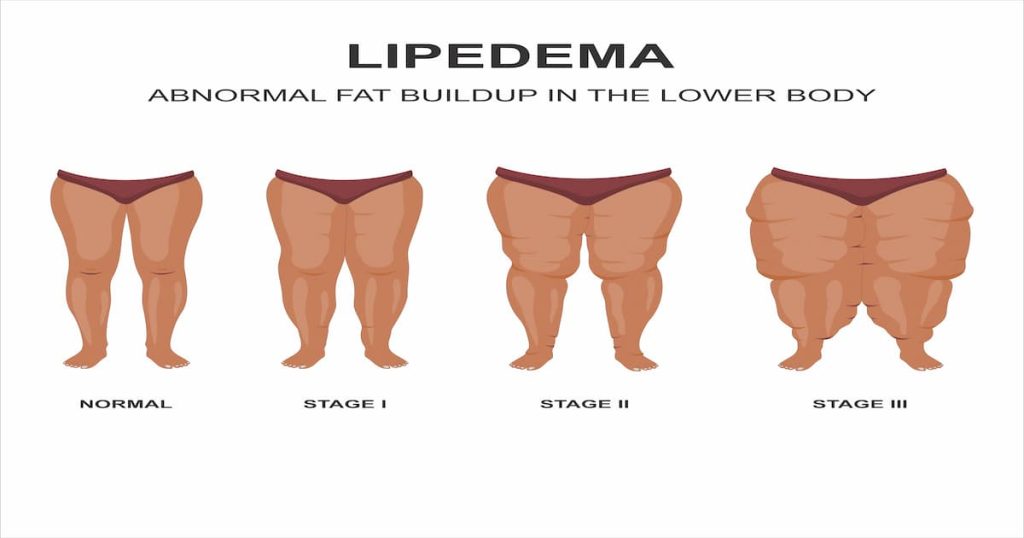 Image illustrant les 4 stades de lipoèdeme