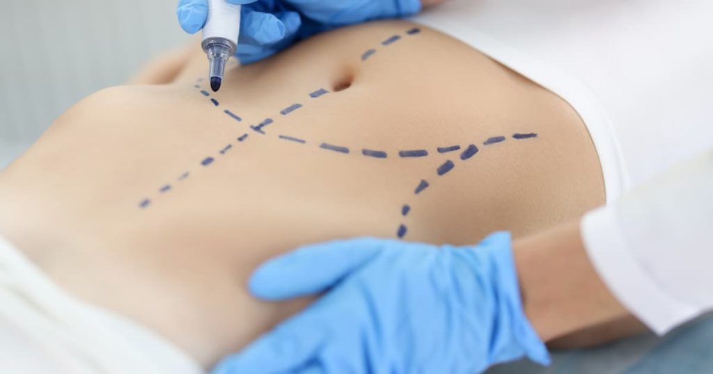 Préparation à une opération de liposuccion