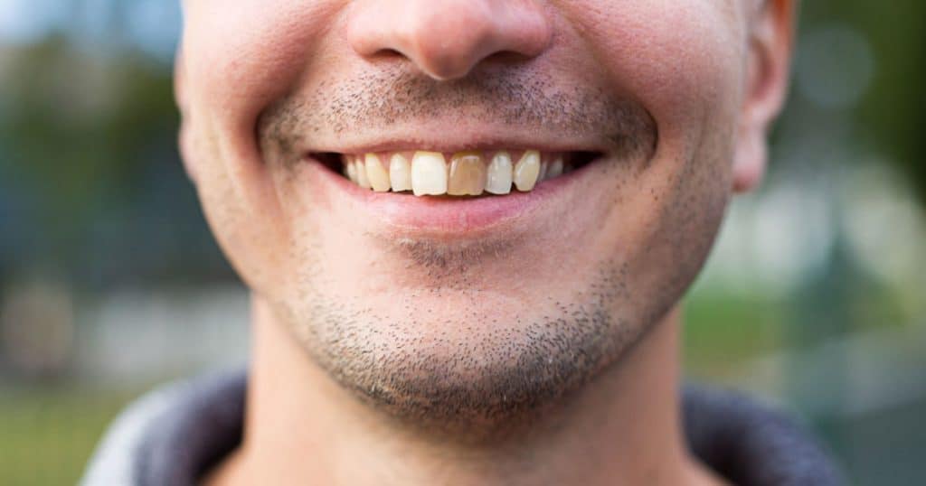 Photo du bas du visage d'un homme souriant. L'incisive centrale droite est grisâtre et semble morte. 