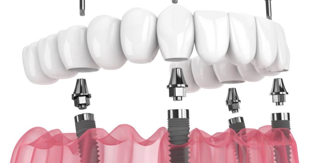 Illustration d'une prothèse dentaire sur implant pour l'arcade inférieure. Quatre implants sont insérés dans la gencive, puis la prothèse est posée sur la gencive et fixée aux quatre points d'attache prodigués par les implants. 