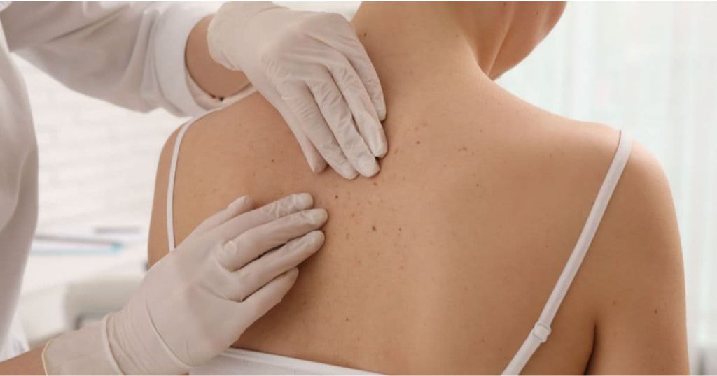 Een dermatoloog met witte handschoenen bestudeert een reeks vlekjes op de rug van een vrouwelijke patiënte.