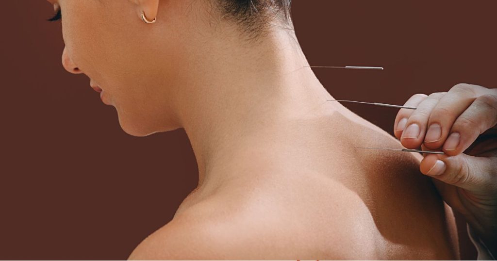 Close-up van de nek en schouders van een patiënt bij de acupuncturist, tegen een donkerbruine achtergrond. De acupuncturist, waarvan enkel de hand in beeld is, brengt de acupunctuurnaalden in langs de ruggengraat van de patiënt.