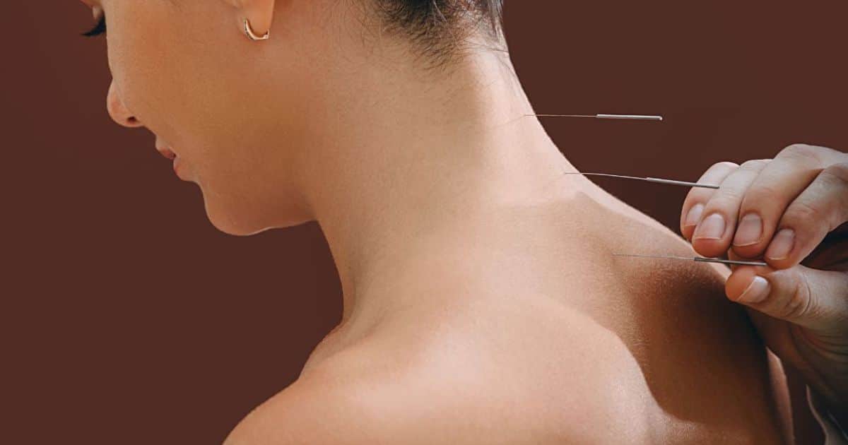 Close-up van de nek en schouders van een patiënt bij de acupuncturist, tegen een donkerbruine achtergrond. De acupuncturist, waarvan enkel de hand in beeld is, brengt de acupunctuurnaalden in langs de ruggengraat van de patiënt.