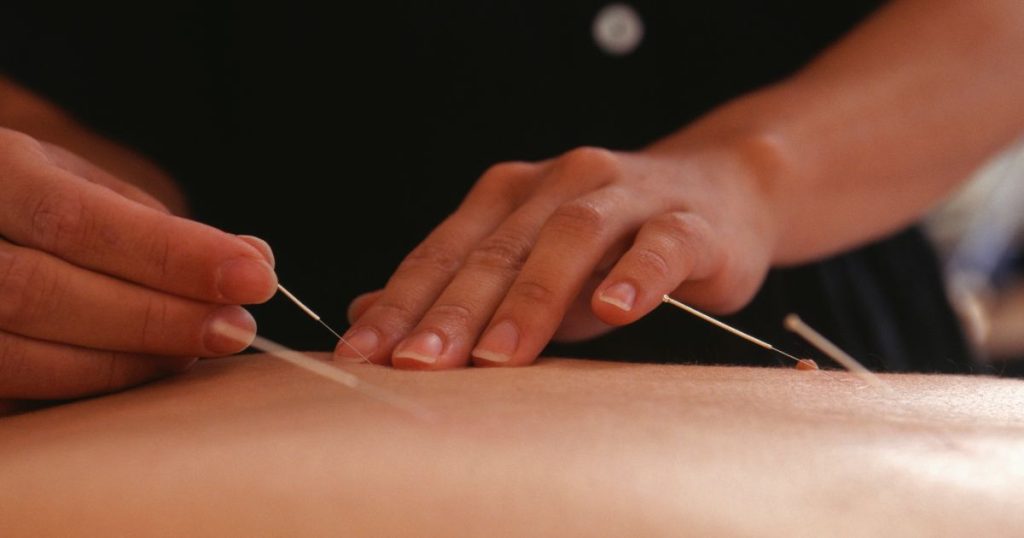 De twee handen van een acupuncturist brengen voorzichtig een naald in in de rug van de patiënt, van wie enkel de rug zichtbaar is. Er zitten al 3 andere naalden in de huid op de rug.