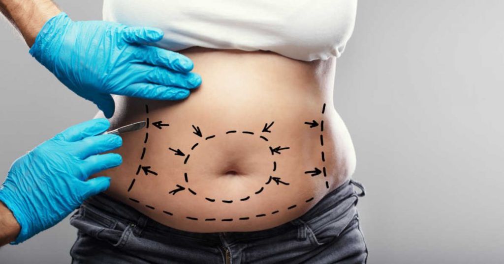 2 Handen in blauwe handschoenen voor chirurgisch gebruik, zijn gericht op de onderbuik van een patiënte. Er zijn stippellijnen op getekend en zwarte pijlen wijzen in diverse richtingen. Één hand houdt iets dat lijkt op een incissiemesje tussen de vingers vast.