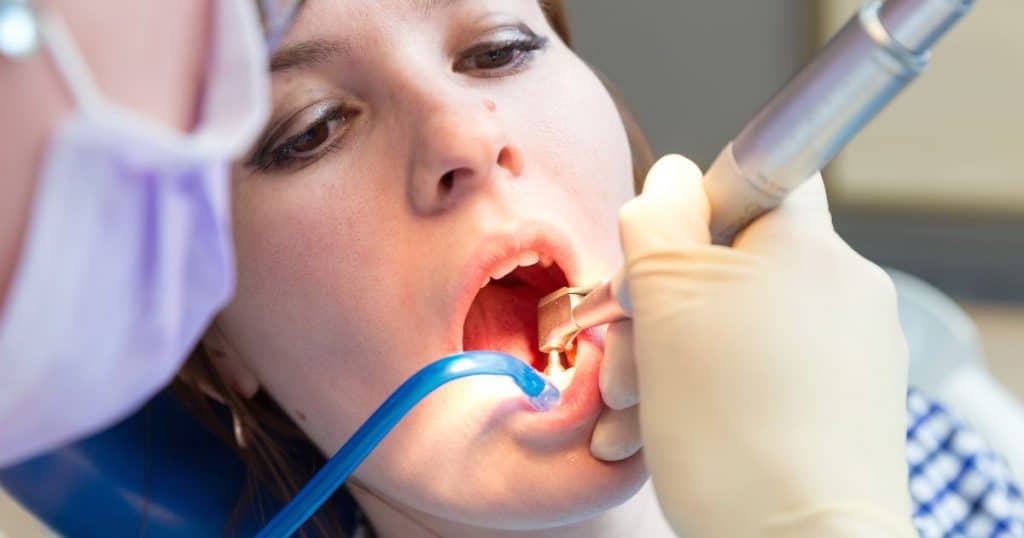 dieptereiniging tanden