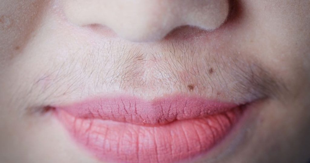 Hirsutisme of hypertrichose? Deze - vermoedelijk - vrouwelijke persoon ondervindt hinder van overmatige beharing onder de neus. Door medische laserontharing kan ze dit verhelpen. Plus, geniet ze mogelijks ook een terugbetaling door haar ziekenfonds.