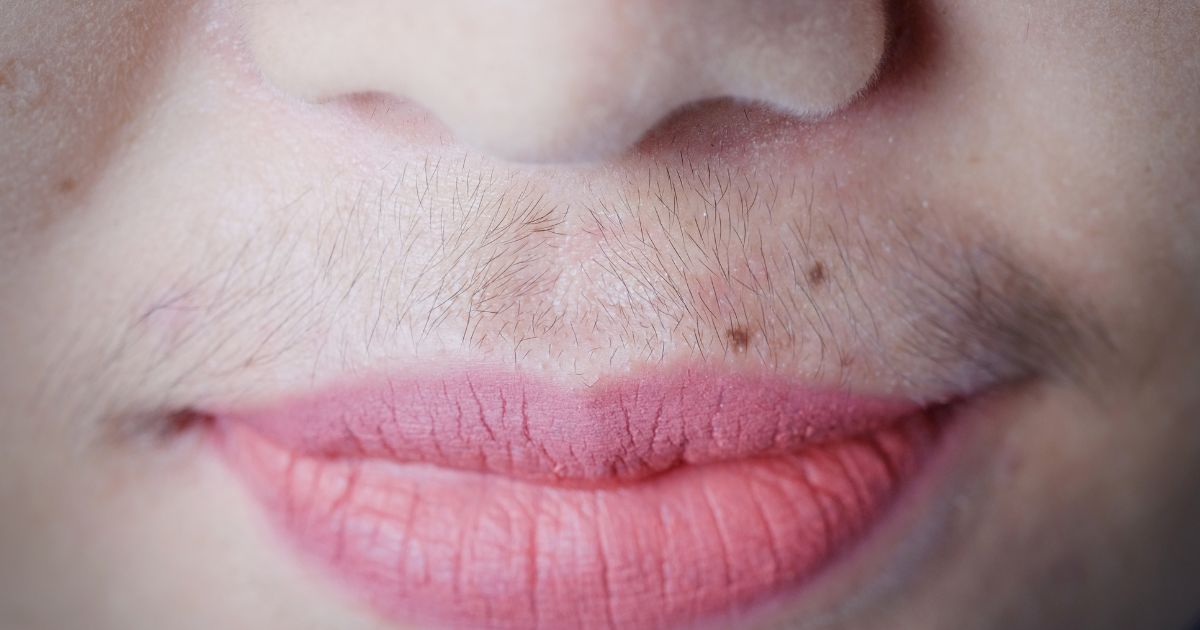 Hirsutisme of hypertrichose? Deze - vermoedelijk - vrouwelijke persoon ondervindt hinder van overmatige beharing onder de neus. Door medische laserontharing kan ze dit verhelpen. Plus, geniet ze mogelijks ook een terugbetaling door haar ziekenfonds.