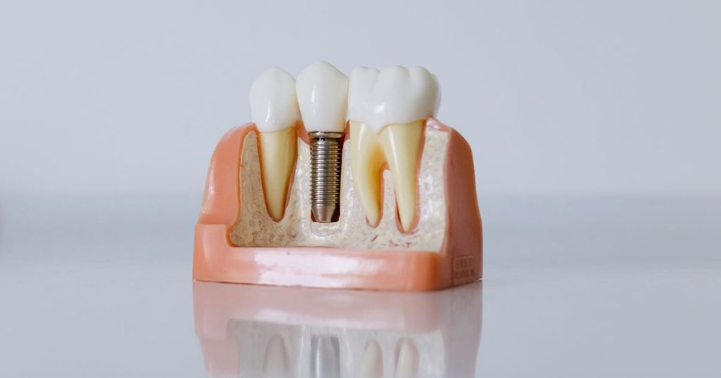 Model van een kaak met een implantaat of kunstwortel met vaste tand, ingeschroefd in het kaakbot, tussen 2 echte tanden met echte tandwortels.