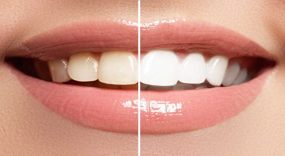 je tanden bleken is de enige manier om tandverkleuring ongedaan te maken