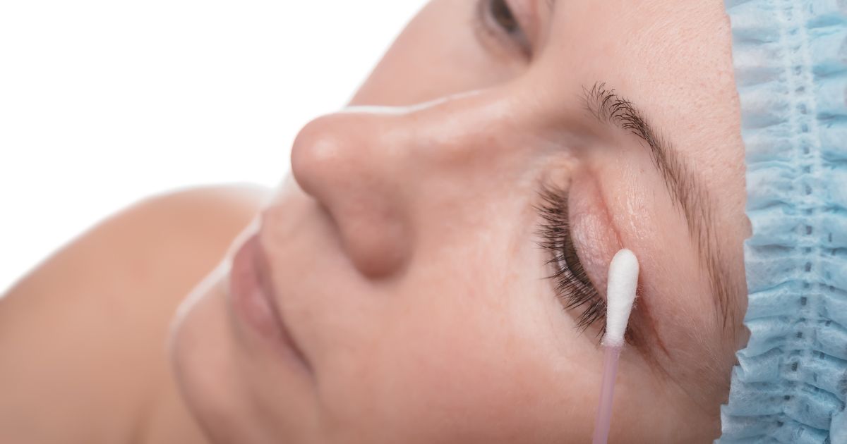 Het gezicht van een vrouw die net een ooglidcorrectie liet uitvoeren. Een wattenstaafje wordt tegen de insnede gehouden.