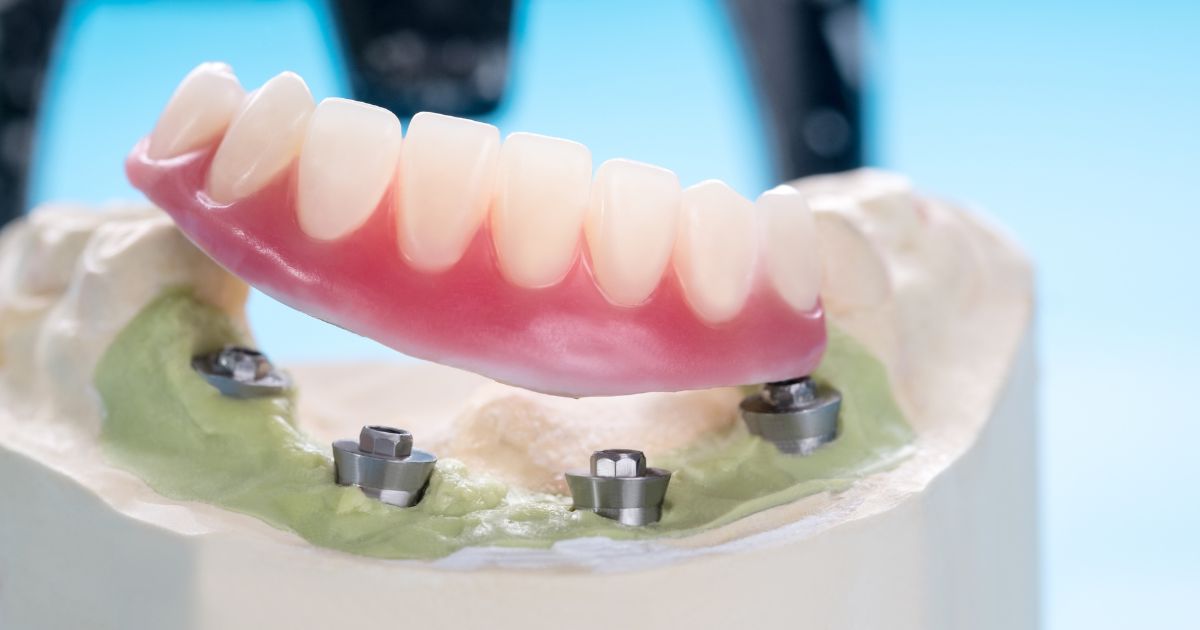Uitneembare prothese over implantaten