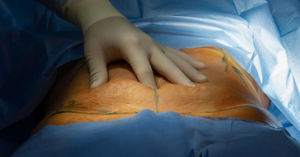 Een chirurg voert een abdominoplastie of buikwandcorrectie uit. De hand van de chirurg zit in een latex handschoen en ligt op de buik van de patiënt.
