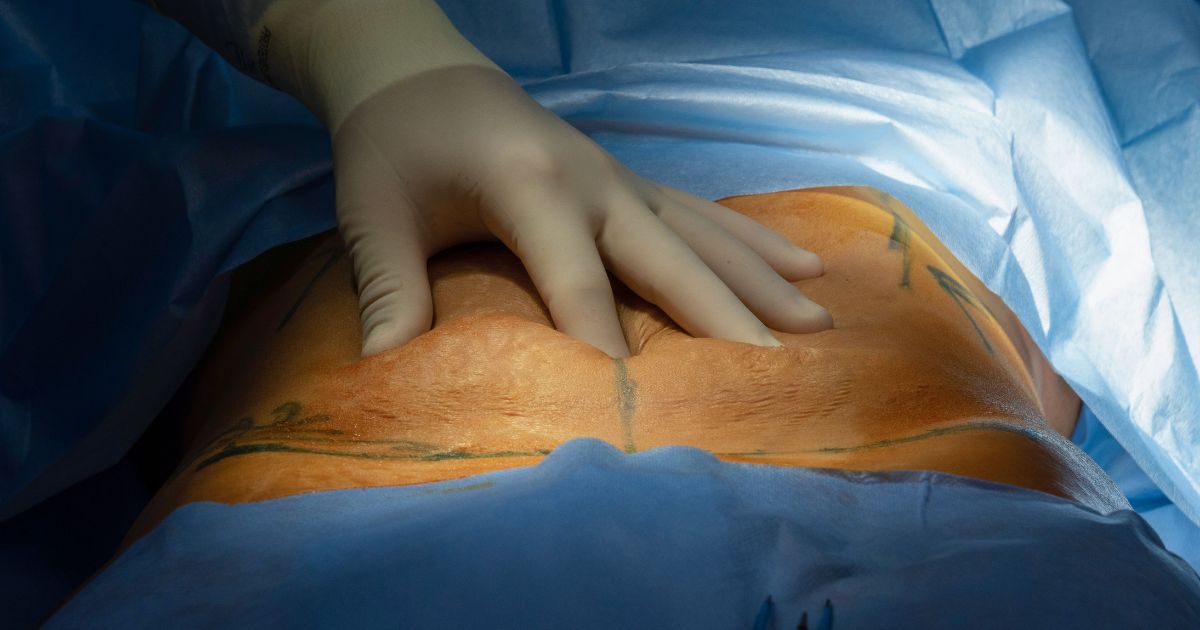 Een chirurg voert een abdominoplastie of buikwandcorrectie uit. De hand van de chirurg zit in een latex handschoen en ligt op de buik van de patiënt.
