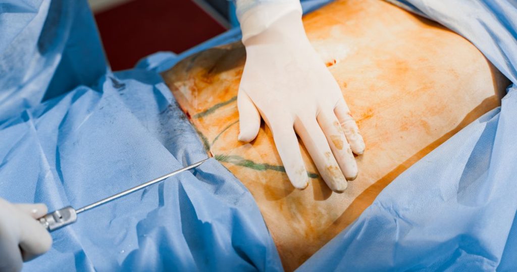 Een chirurg voert een abdominoplastie of buikwandcorrectie uit. De ene hand van de chirurg ligt op de buik, terwijl hij met de andere hand chirurgisch gereedschap vasthoudt.