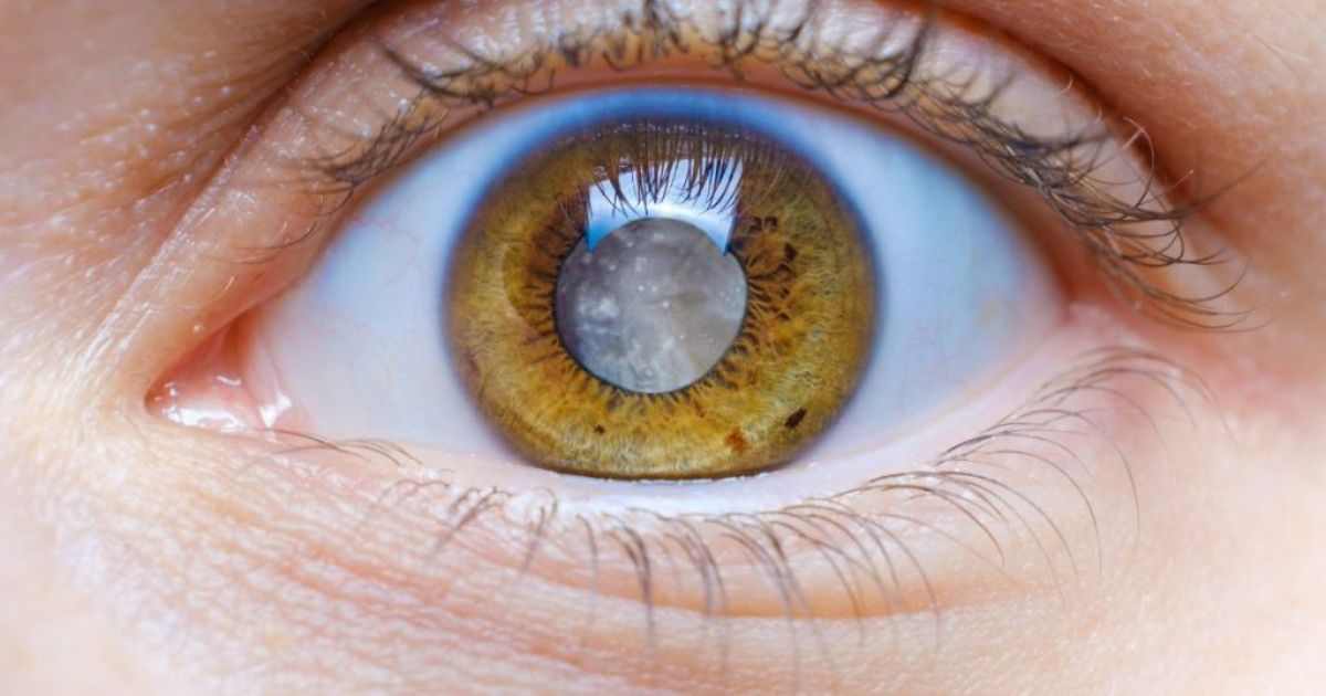Close-up van een lichtbruin oog met cataract of staar.